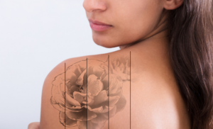 tattoo removal specials