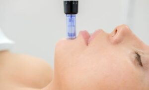 La Glace Aesthetics Sea Point microneedling session cape town spa