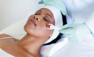 A microneedling treatment from la glace empire